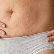 5 Cara Bebas dari Stretch Mark, Kenali Penyebab dan Solusi Menghilangkannya