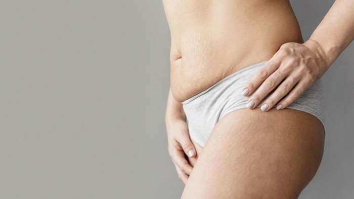 Laser skin resurfacing menggunakan sinar laser pendek untuk mengangkat lapisan kulit area stretch mark secara presisi. Treatment ini aka membantu merangsang serat kolagen yang baru./ Foto: Freepik.com