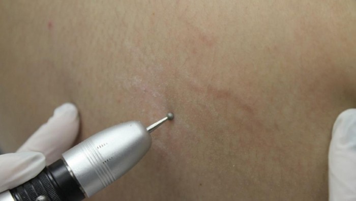 Dermabrasi akan membantu memperbaiki kontur permukaan kulit dan menumbuhkan lapisan kulit baru yang terasa lebih halus./ Foto: springernature.com