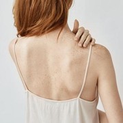 Jerawat di Badan Bikin Resah? Ini 4 Cara Ampuh Mengatasinya!