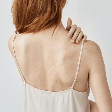 Jerawat di Badan Bikin Resah? Ini 4 Cara Ampuh Mengatasinya!