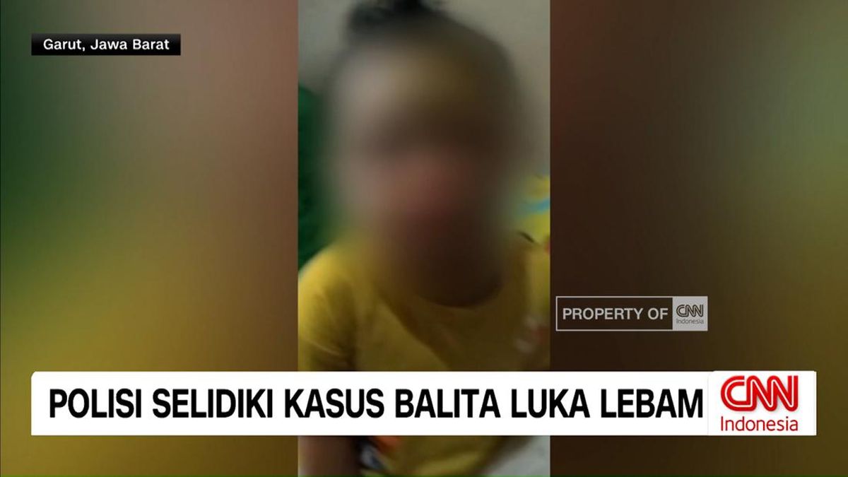 VIDEO: Polisi Selidiki Kasus Balita Luka Lebam