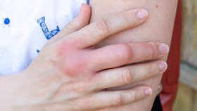 5 Obat Alami untuk Sengatan Tawon yang Sudah Bengkak