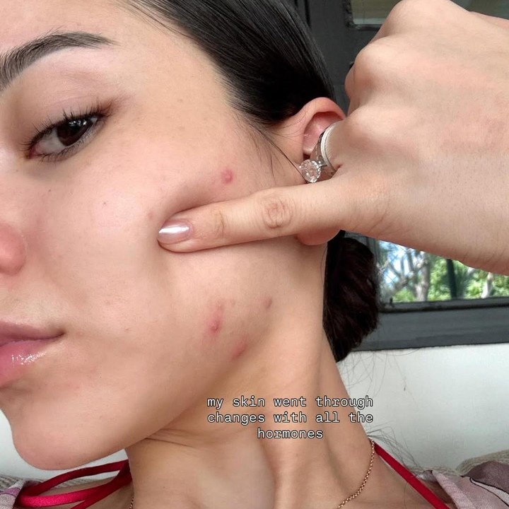 <p>Perempuan keturunan Prancis ini juga bercerita bahwa terjadi perubahan hormon ketika ia hamil pada trimester pertama. Alyssa menunjukkan wajahnya timbul kemerahan dan beberapa jerawat hormon di sekitar tulang rahangnya. (Foto: Instagram @alyssadaguise)</p>