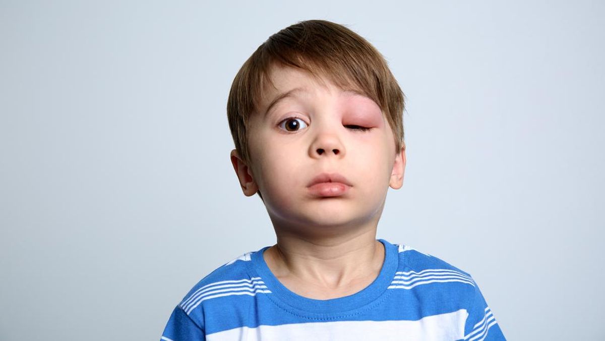 7 Cara Mengobati Mata Bengkak dalam Sekejap