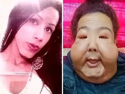 Influencer Disuntik Filler Isi Minyak-Pencahar, Wajahnya Jadi Begini