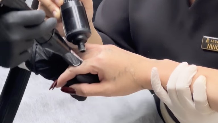 Momen ketika Sheila Marcia menahan sakit karena hapus tato.