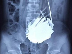 Ratusan Benda Asing Berada dalam Perut Pria 39 Tahun di China