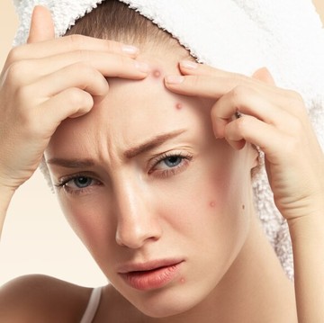 Breakout Terus? Ini 5 Makanan yang Jarang Disadari Bisa Bikin Jerawat Muncul!