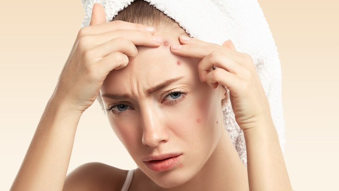 Breakout Terus? Ini 5 Makanan yang Jarang Disadari Bisa Bikin Jerawat Muncul!