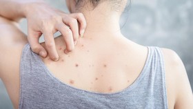 Jerawat Punggung Tak Kunjung Hilang, Coba 8 Cara Mengatasinya