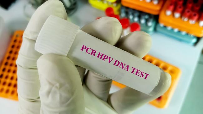 Tes HPV DNA, Alternatif untuk Mendeteksi Kanker Serviks Selain Pap Smear