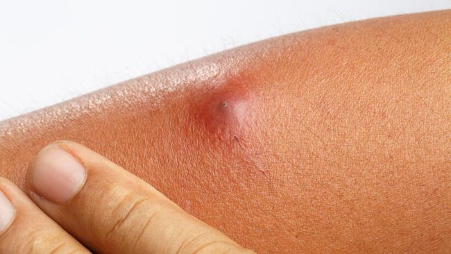 Memecahkan bisul yang mengeras memicu risiko lain. Lantas, bagaimana cara menghilangkan bisul yang mengeras tanpa perlu dipecahkan?