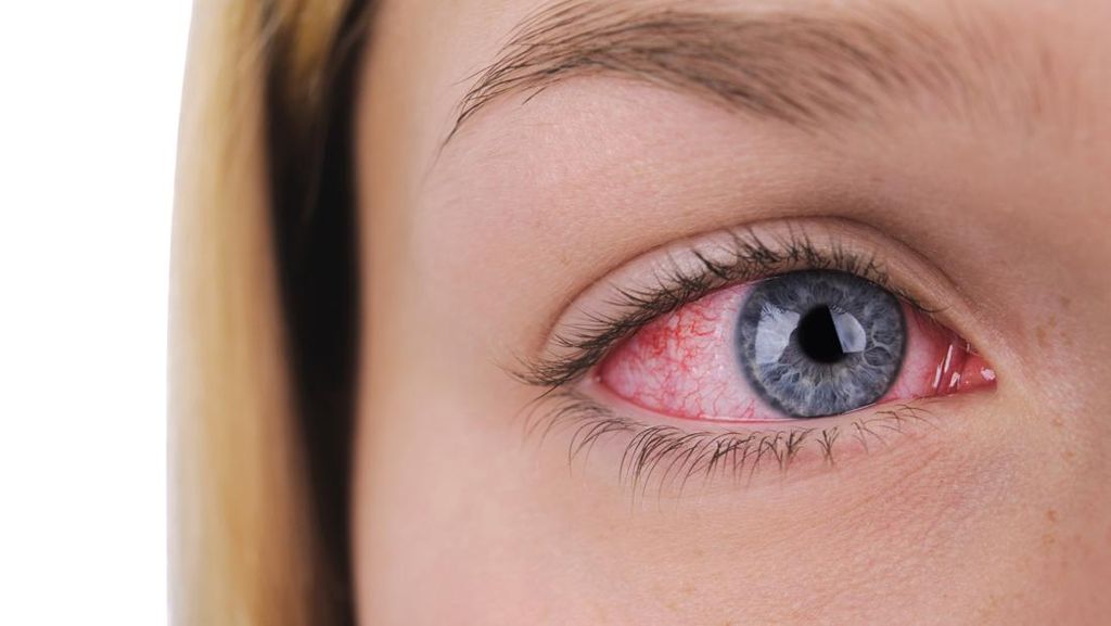 Urat Merah di Mata, Apakah Berbahaya? Ini Penjelasannya