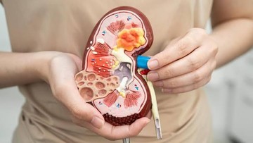 6 Ciri-ciri Gagal Ginjal, Kenali Lebih Awal Demi Penanganan Cepat