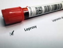 Kronologi WNI di Rumania Terkena Kusta, Jadi Kasus Pertama usai 44 Tahun