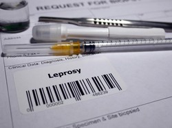 WNI Jadi Kasus Pertama Kusta di Rumania setelah 44 Tahun, Keluhkan Gejala Ini