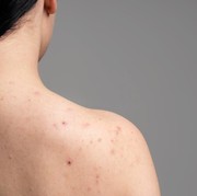 5 Cara Mengatasi Jerawat Punggung agar Kulit Kembali Mulus