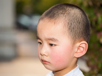 Tampek pada Anak: Penyebab, Gejala, Cara Mengobati & Bedanya dengan Campak
