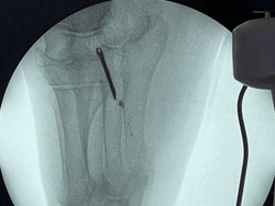 Ngilu! Besi 6,5 Cm Nancap di Kaki Nenek Selama Puluhan Tahun
