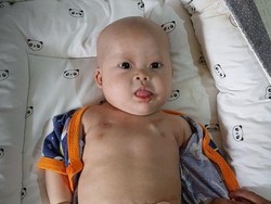 Kisah Chiara Bayi Penderita Tumor Teratoma Immature, Berjuang Ingin Sembuh