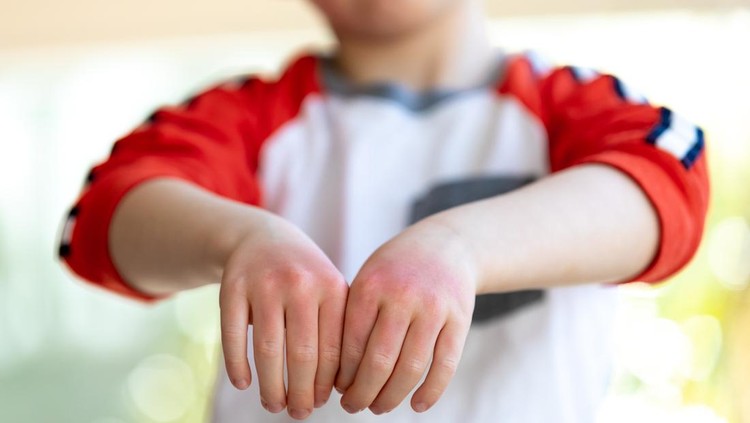 12 jenis gatal pada anak