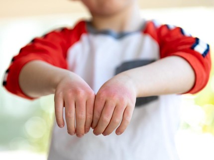 12 Jenis Penyakit Gatal pada Kulit yang Bisa Menyerang Anak
