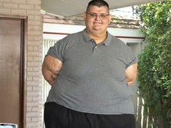 Tragis, Pria Tergemuk di Dunia Meninggal Usai Idap Penyakit Ini