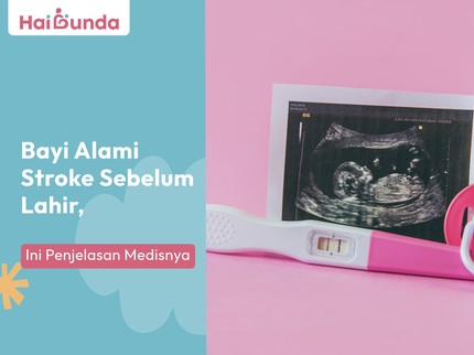 Bayi Alami Stroke Sebelum Lahir, Ini Penjelasan Medisnya