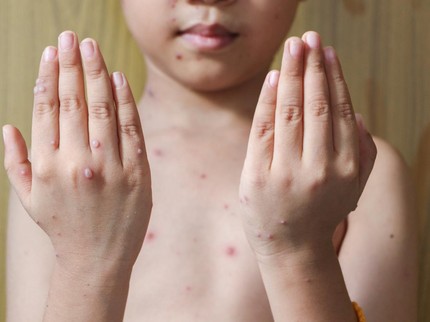 Dokter Ungkap Cacar Air Bisa Menular ke 12 Anak, Hati-hati di Sekolah!