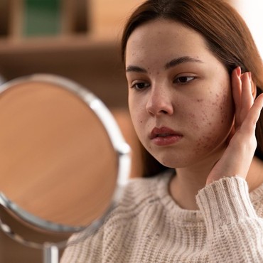 Ingin Noda Hitam Bekas Jerawat Hilang? Ini Kandungan Penting yang Harus Ada di Serum