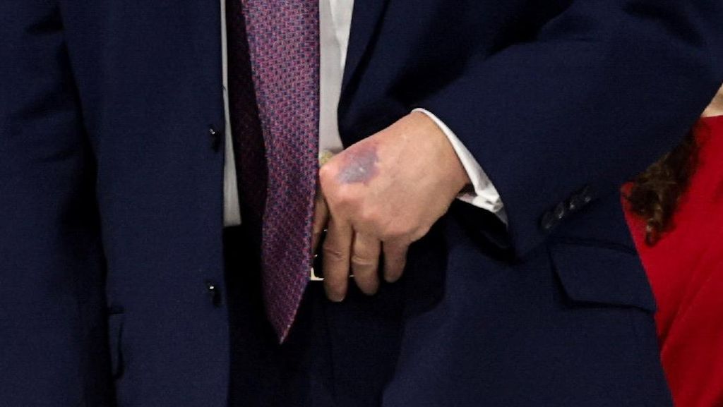 Wujud Tangan Trump Memar usai WEF, Klaim Terbentur Meja