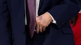 Wujud Tangan Trump Memar usai WEF, Klaim Terbentur Meja