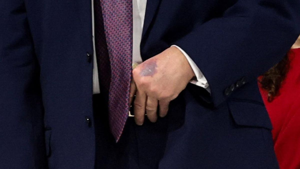 Wujud Tangan Trump Memar usai WEF, Klaim Terbentur Meja