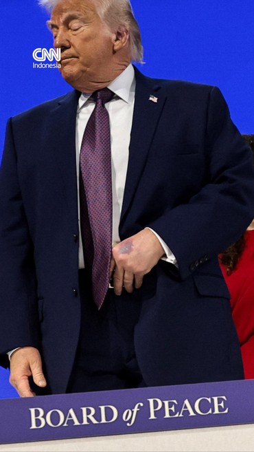 Wujud Tangan Trump Memar usai WEF, Klaim Terbentur Meja