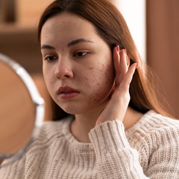 5 Langkah Efektif Memperbaiki Skin Barrier Rusak Tanpa Biaya Besar