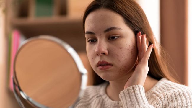 5 Langkah Efektif Memperbaiki Skin Barrier Rusak Tanpa Biaya Besar