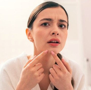 7 Arti Letak Jerawat yang Ternyata Berkaitan dengan Kebiasaan Sehari-hari