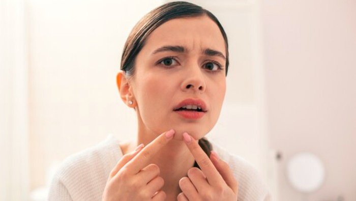7 Arti Letak Jerawat yang Ternyata Berkaitan dengan Kebiasaan Sehari-hari