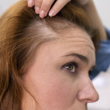 Apakah Kondisi Kulit Kepala Tak Sehat Bisa Picu Kebotakan? Ini Kata Ahli