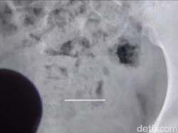 Jarum Pentul Tertelan, Remaja Sumedang Dilarikan ke RS