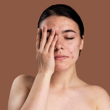 5 Makanan Sehari-hari yang Memicu Jerawat dan Komedo