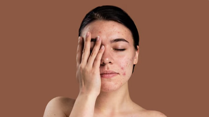5 Makanan Sehari-hari yang Memicu Jerawat dan Komedo