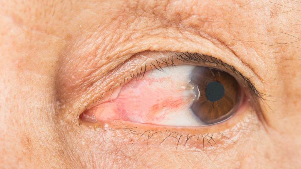 5 Kondisi Ini Jadi Penyebab Lemak Mata, Apa Saja Faktor Risikonya?