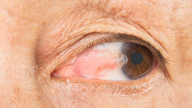 Ada beberapa kondisi yang menjadi penyebab lemak mata. Apa saja itu?