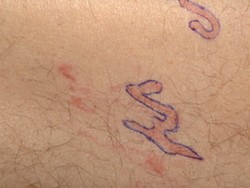 Pria Heran Ruam Kulitnya Bergerak, Rupanya Ada Cacing yang Merayap