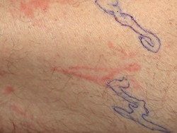 Ngeri! Ruam Kulit Pria Ini Bergerak, Ternyata Ada Cacing Merayap