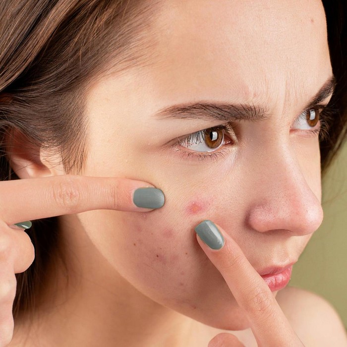 Gaya Hidup yang Bikin Wajah Breakout