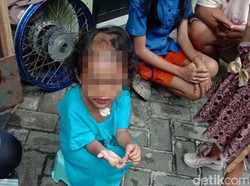 Balita di Surabaya 2 Bulan Disiksa Paman dan Bibi hingga Kepalanya Botak