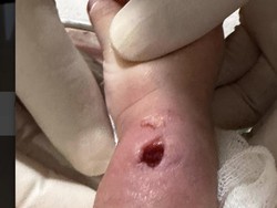 Viral Tangan Bayi Bengkak-Berlubang Usai Diinfus di RS Paramount Makassar